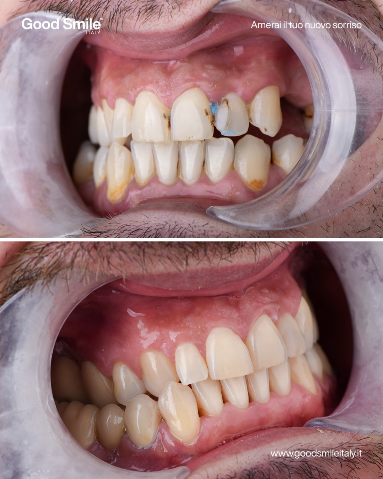 Trabucco prima e dopo 2