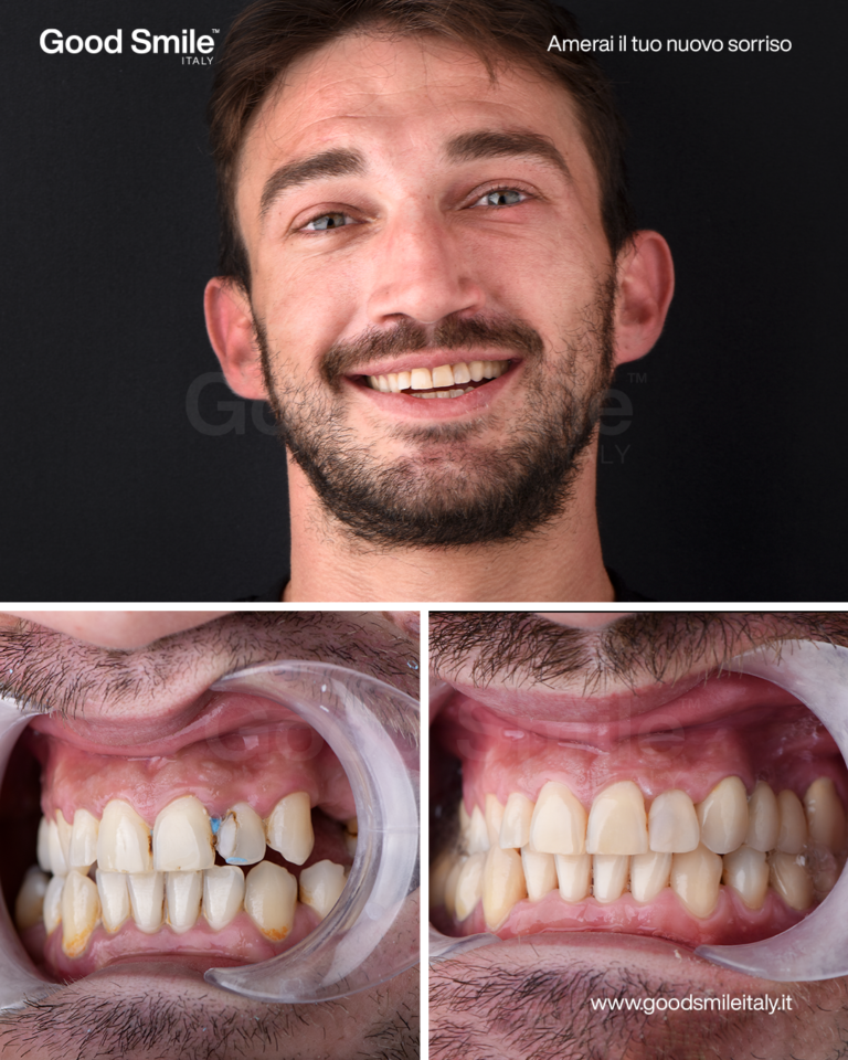 Trabucco prima e dopo